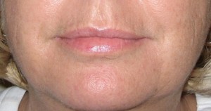 Dermal Fillers from Dr Jeremy Hunt